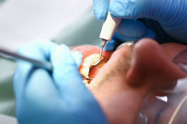 Best Dentist for Tooth Abscess  in Stratmoor, CO